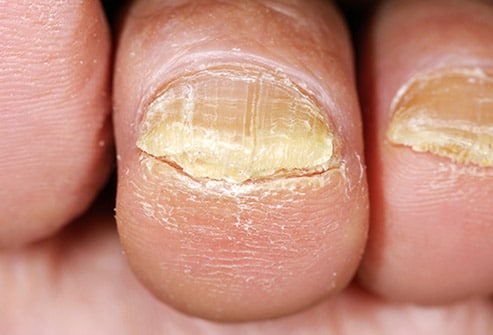 toe nail fungus